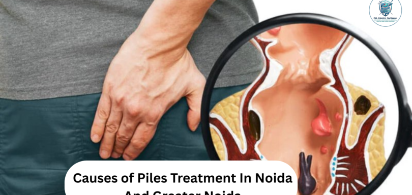 Causes of piles showing common risk factors including constipation, pregnancy, obesity, prolonged sitting, and low-fiber diet.