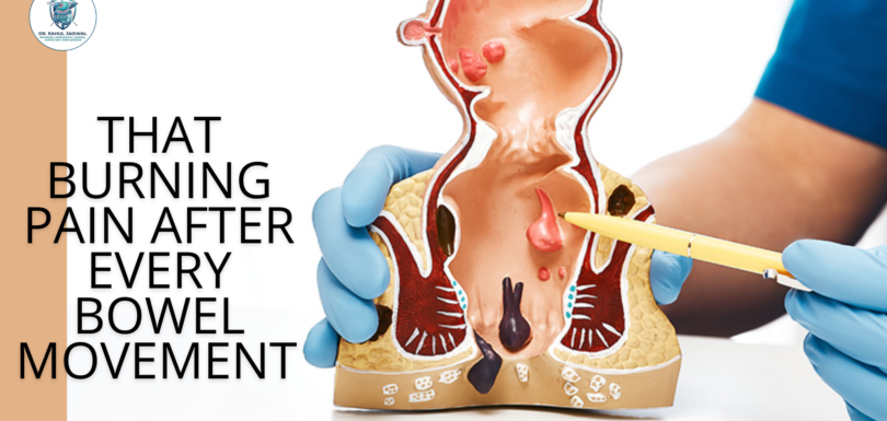 Anal fissure treatment in Noida